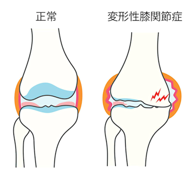 膝の疾患症状