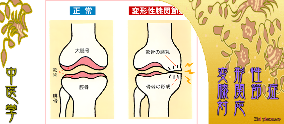 変形性膝関節症（Top-）