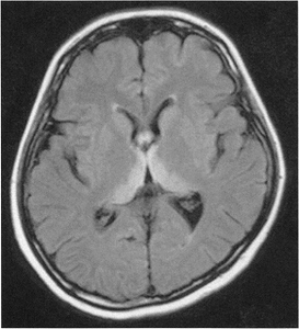 インフルエンザ脳症