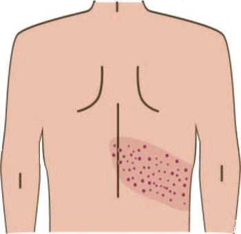 帯状疱疹（たいじょうほうしん）