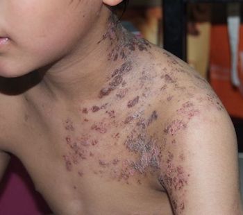 帯状疱疹（たいじょうほうしん）