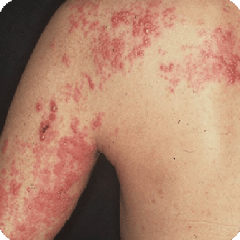 帯状疱疹（たいじょうほうしん）