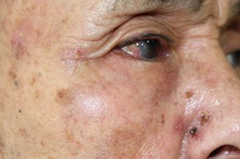 帯状疱疹（たいじょうほうしん）