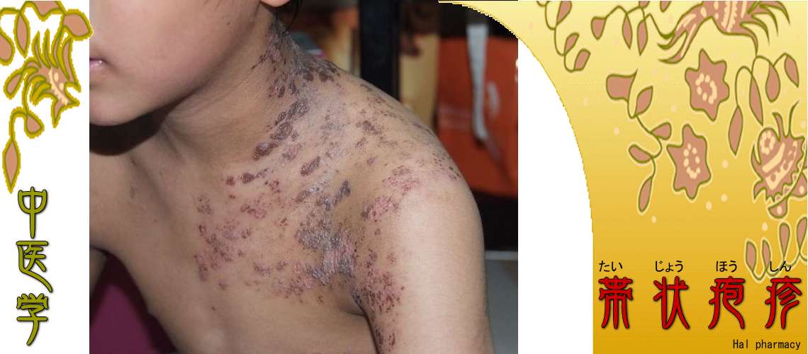 帯状疱疹（予防-）