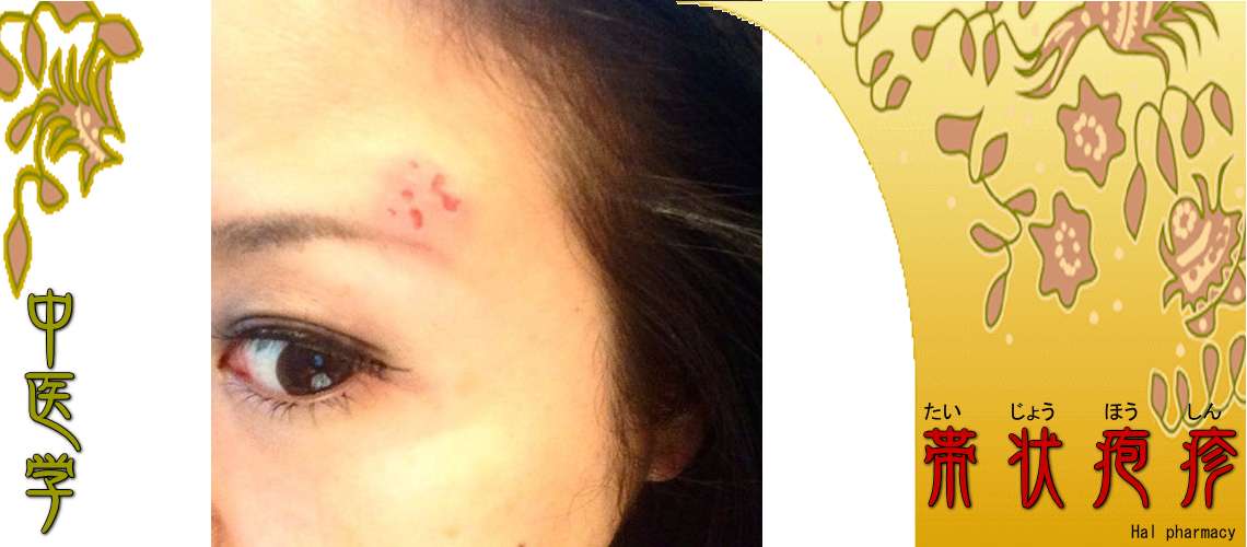 帯状疱疹（予防-）