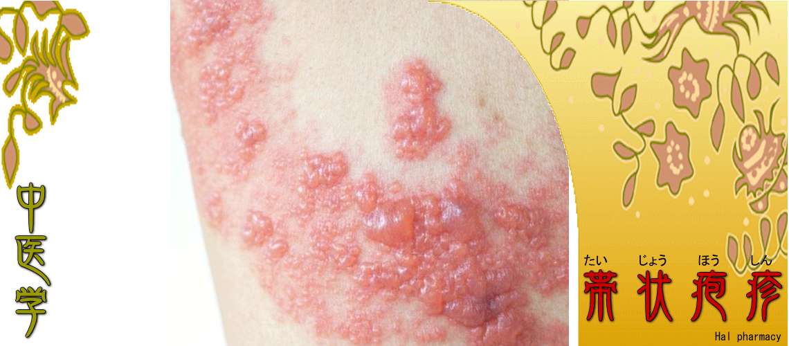 帯状疱疹（Top-）